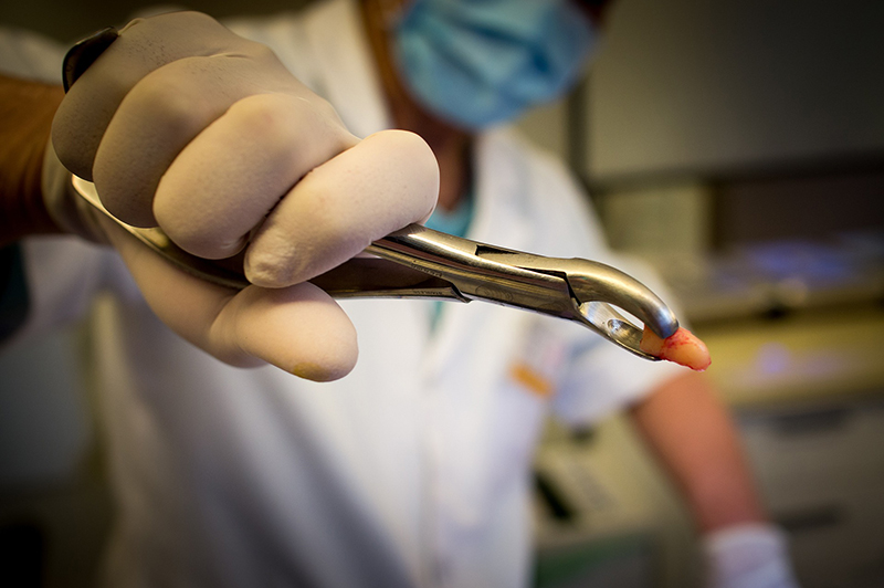 tooth extraction
